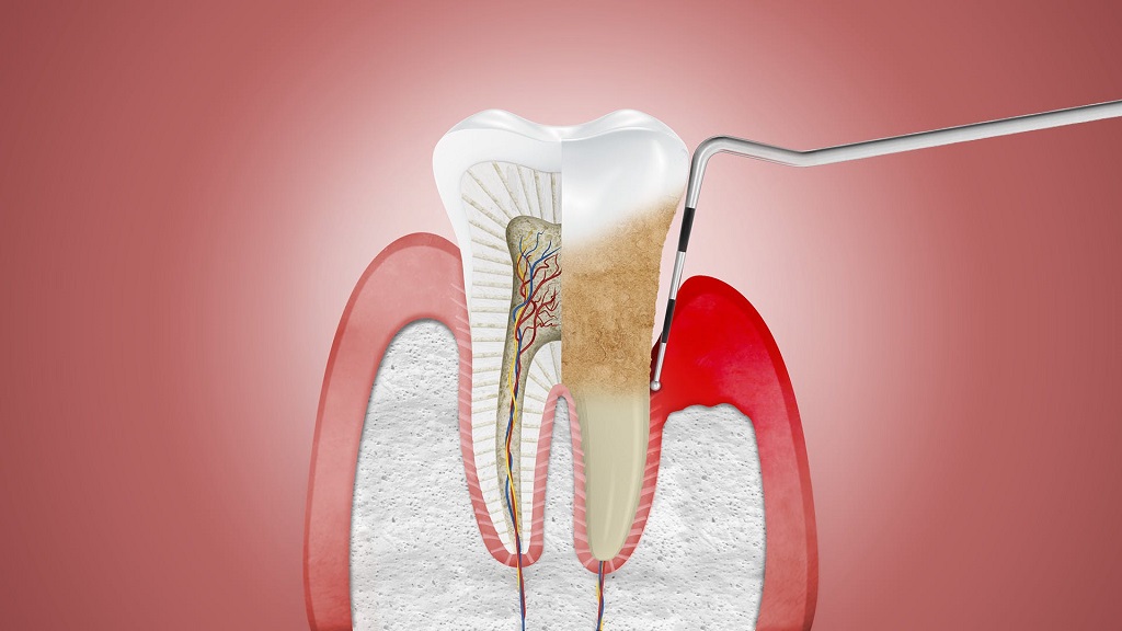 Periodontitis