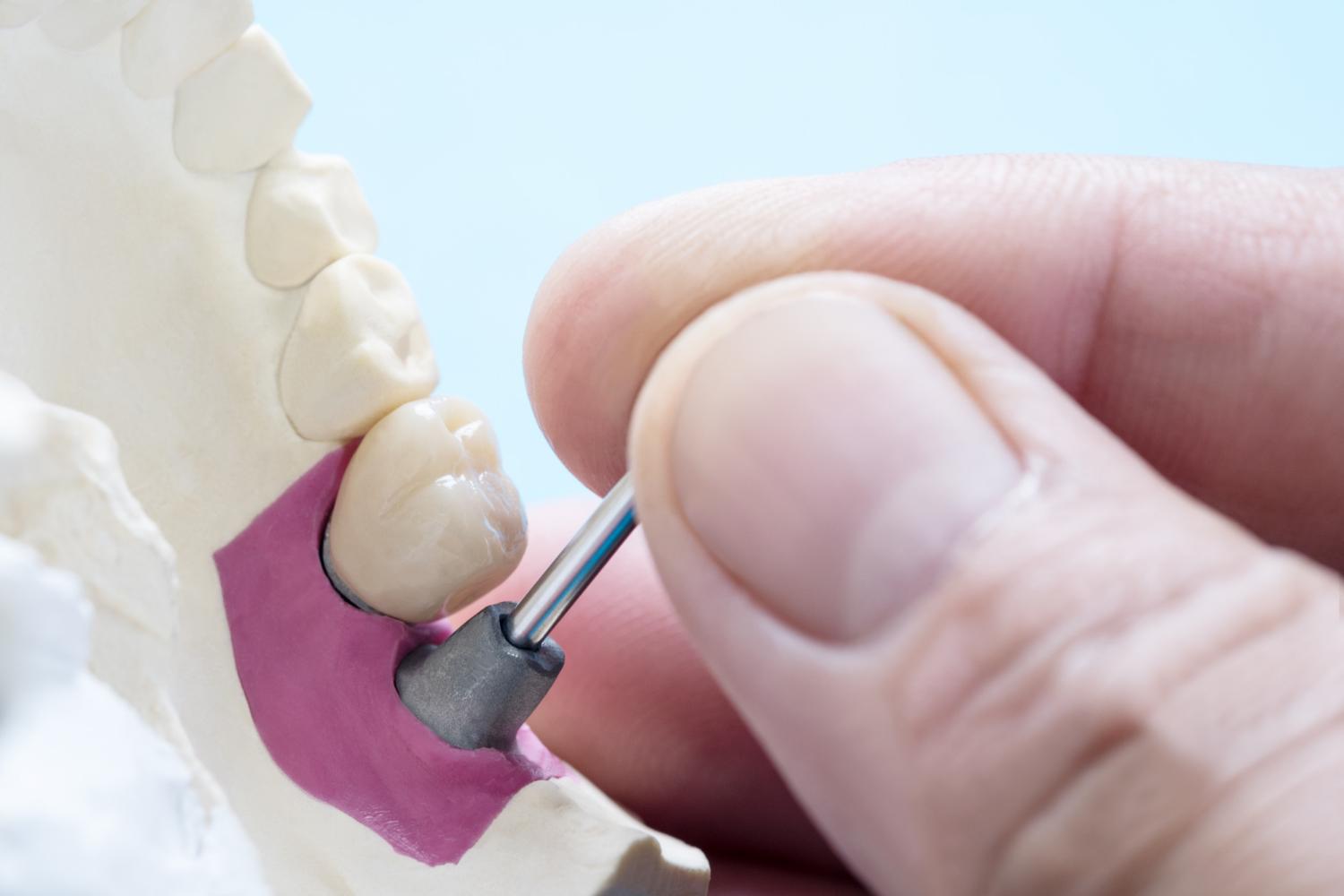 Beneficios de los implantes dentales